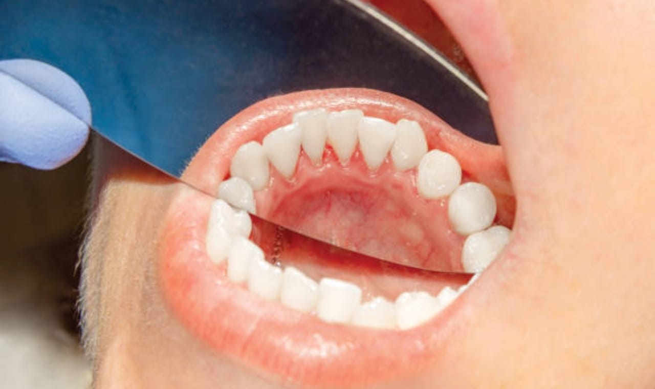 Oral Cancer Symptoms: ह्या लक्षणांकडे दुर्लक्ष करणे धोकादायक